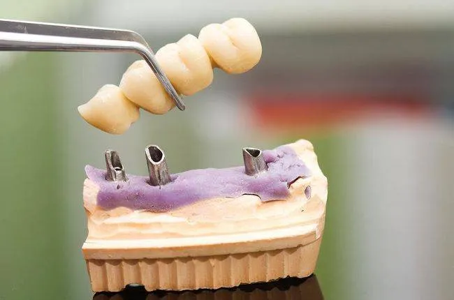 Dental Bridges